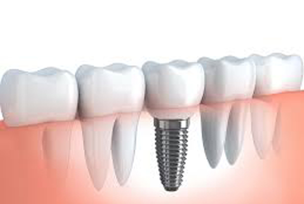 DENTAL IMPLANT CLINIC